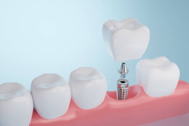 Implantes vs. Dentaduras Postizas