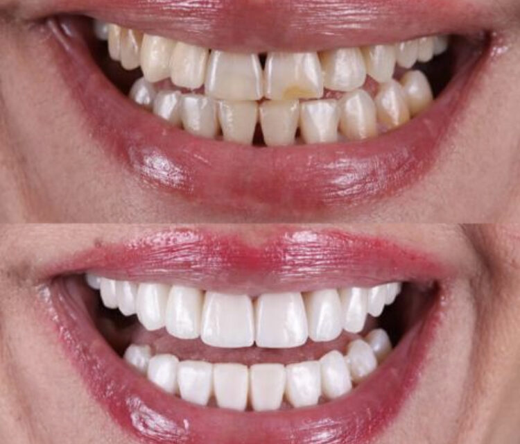 ¿Tienes diastema? Tratamientos efectivos para cerrar los dientes separados