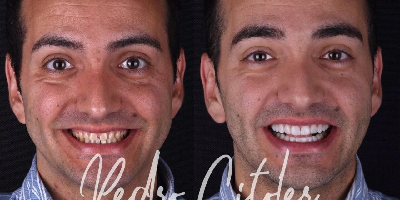 Carillas dentales: la mejor opción