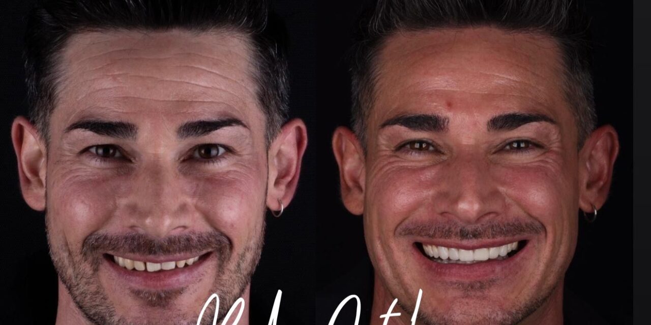 Estética dental masculina: transforma rasgos y expresa personalidad