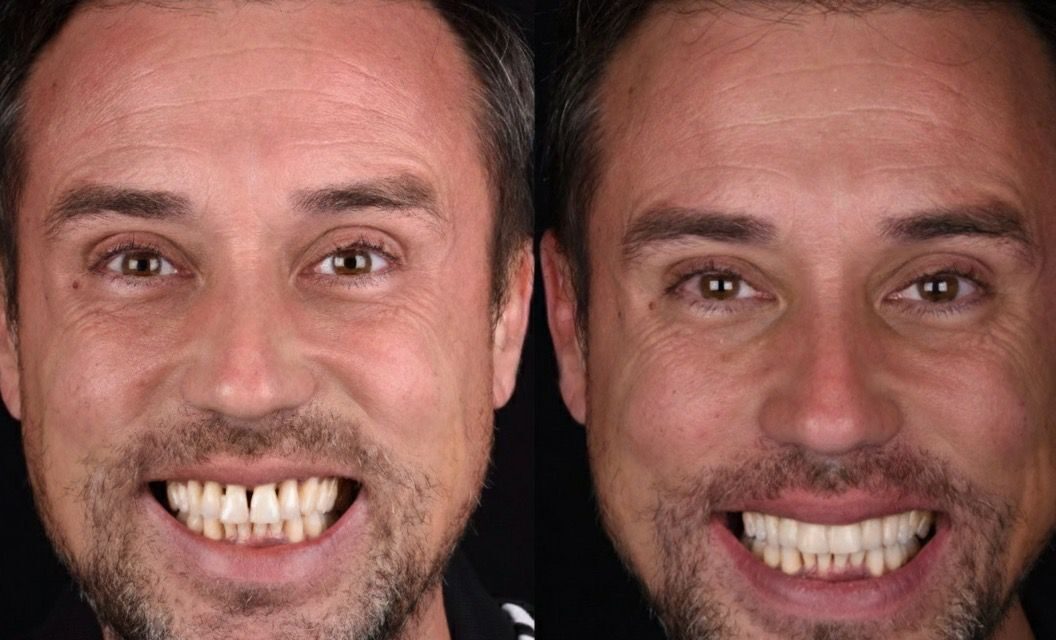 Cambia tu sonrisa en 2 horas: el arte de las carillas de composite en Pedro Citoler