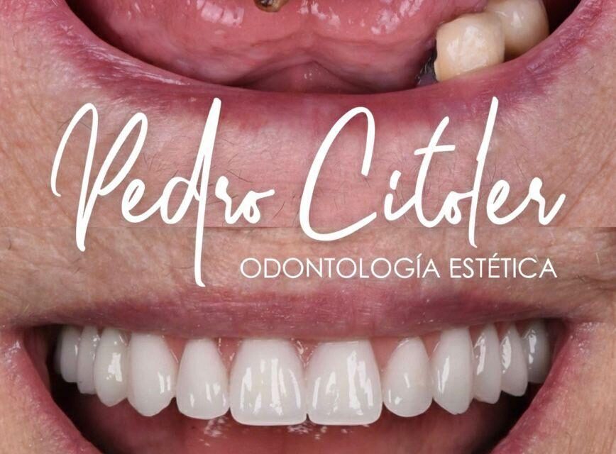 Implantes en carga inmediata en España: qué debe exigir antes de tomar una decisión