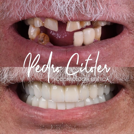 Más allá del resultado: cómo se construye una sonrisa de alto nivel