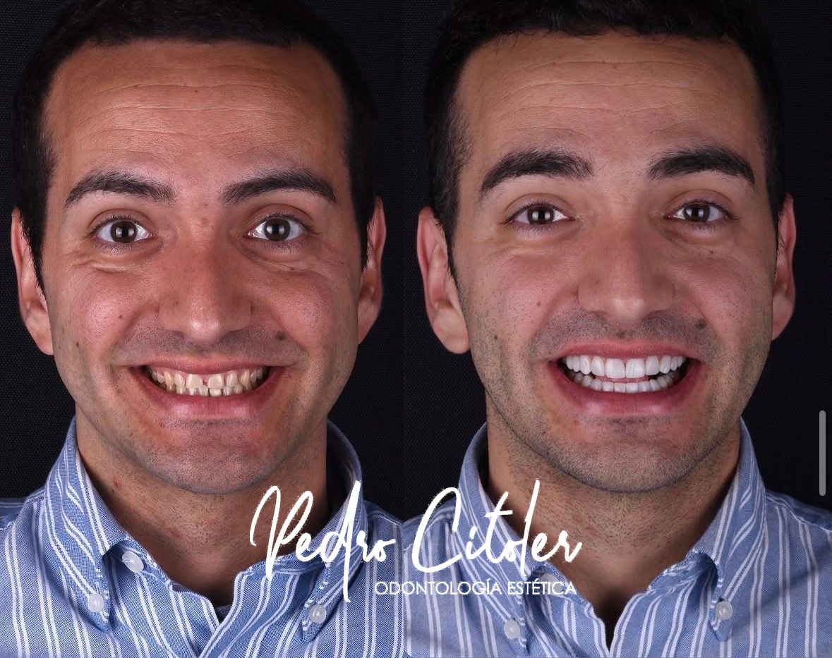Carillas dentles - Pedro Citoler