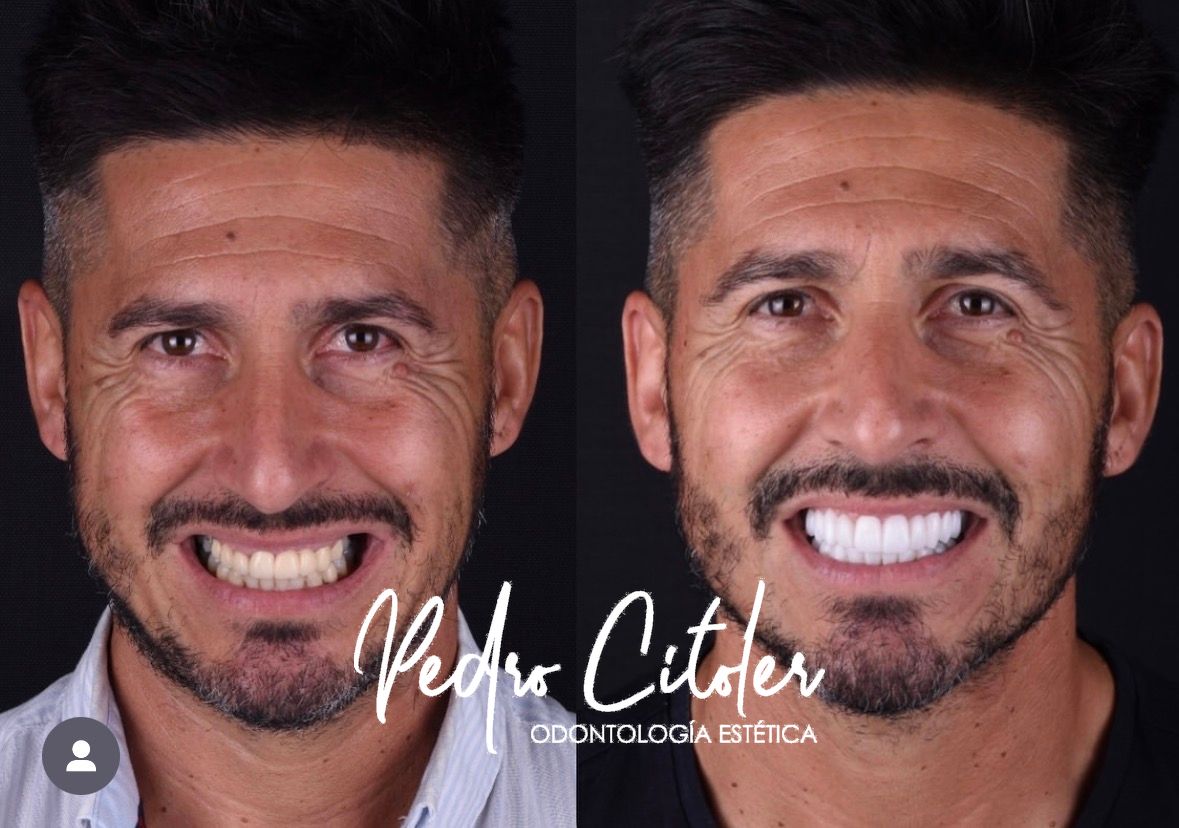 Carillas dentles - Pedro Citoler