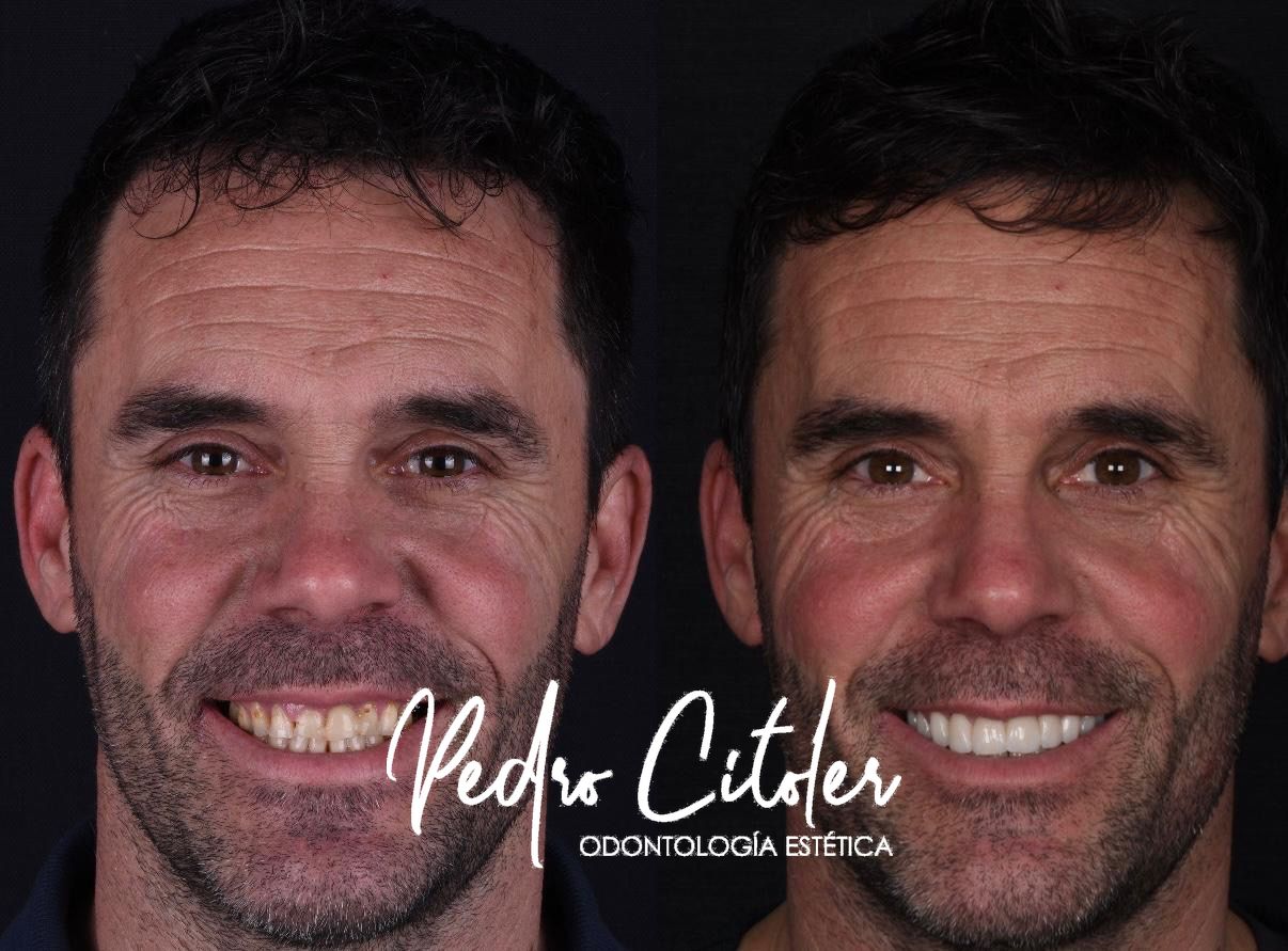 Carillas dentles - Pedro Citoler