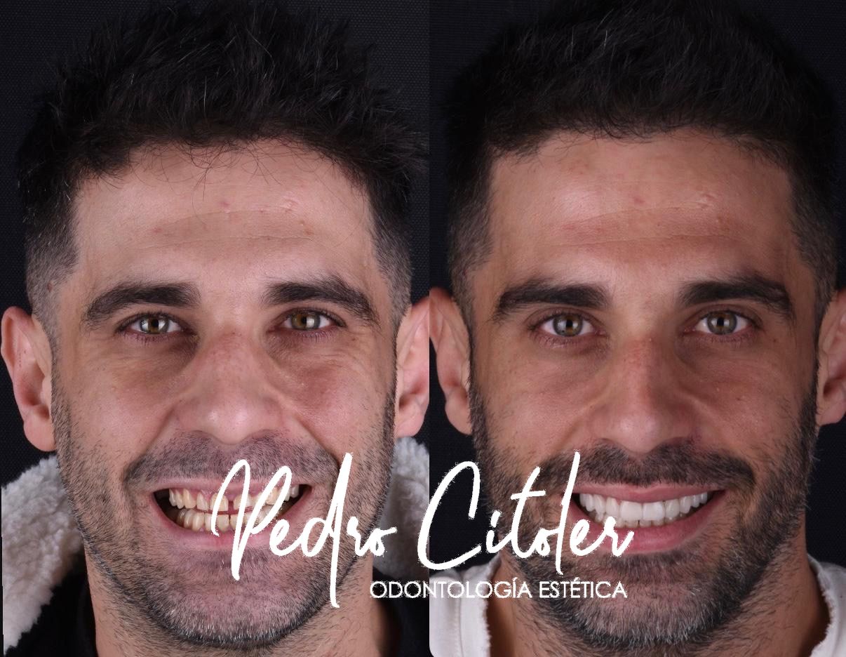 Carillas dentles - Pedro Citoler