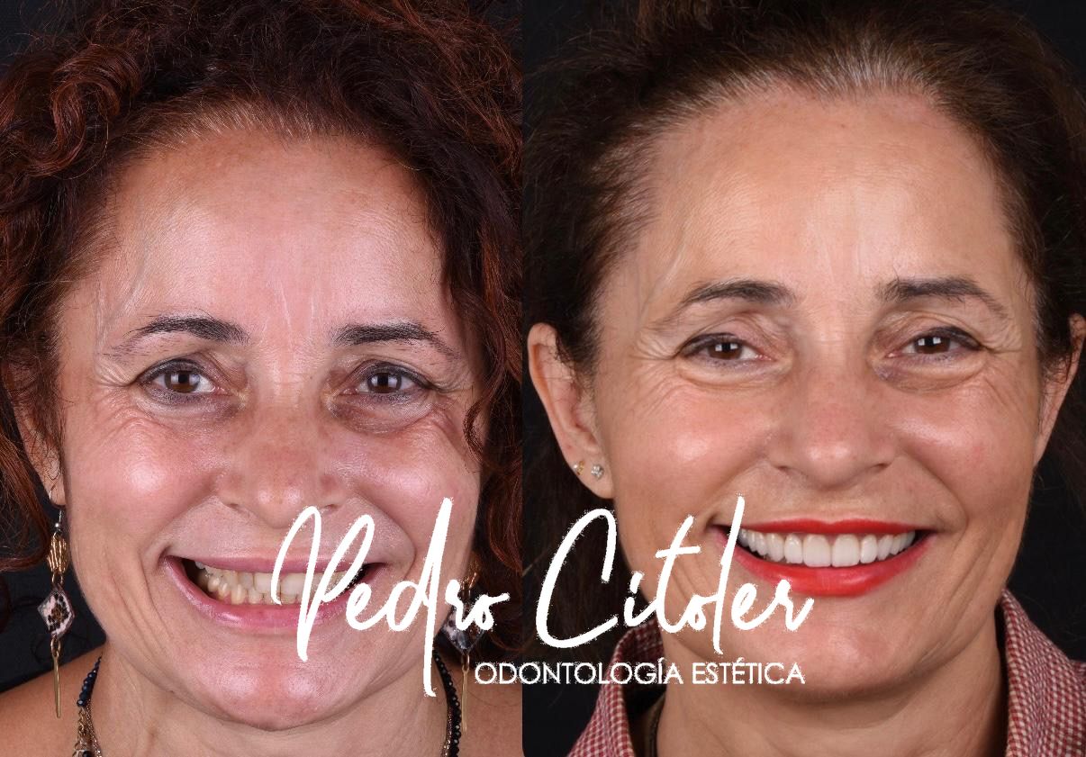 Carillas dentles - Pedro Citoler