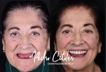 Pedro Citoler Odontología Estética, reconocida por Sweden & Martina entre las mejores clínicas de implantes dentales y tecnología digital de España