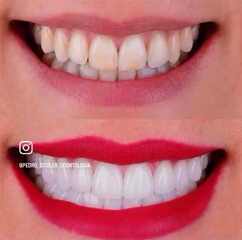 La tranquilidad de saber que ha elegido bien: lo que ocurre después de un tratamiento dental excelente